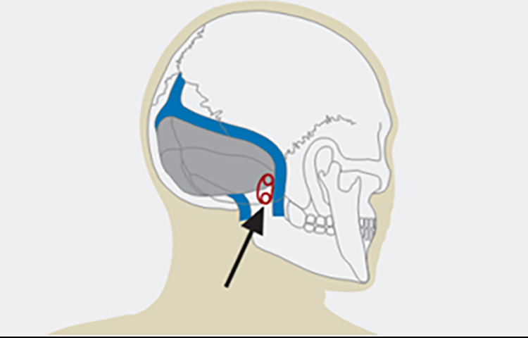 Hemifacial spasm: Conservative and surgical options